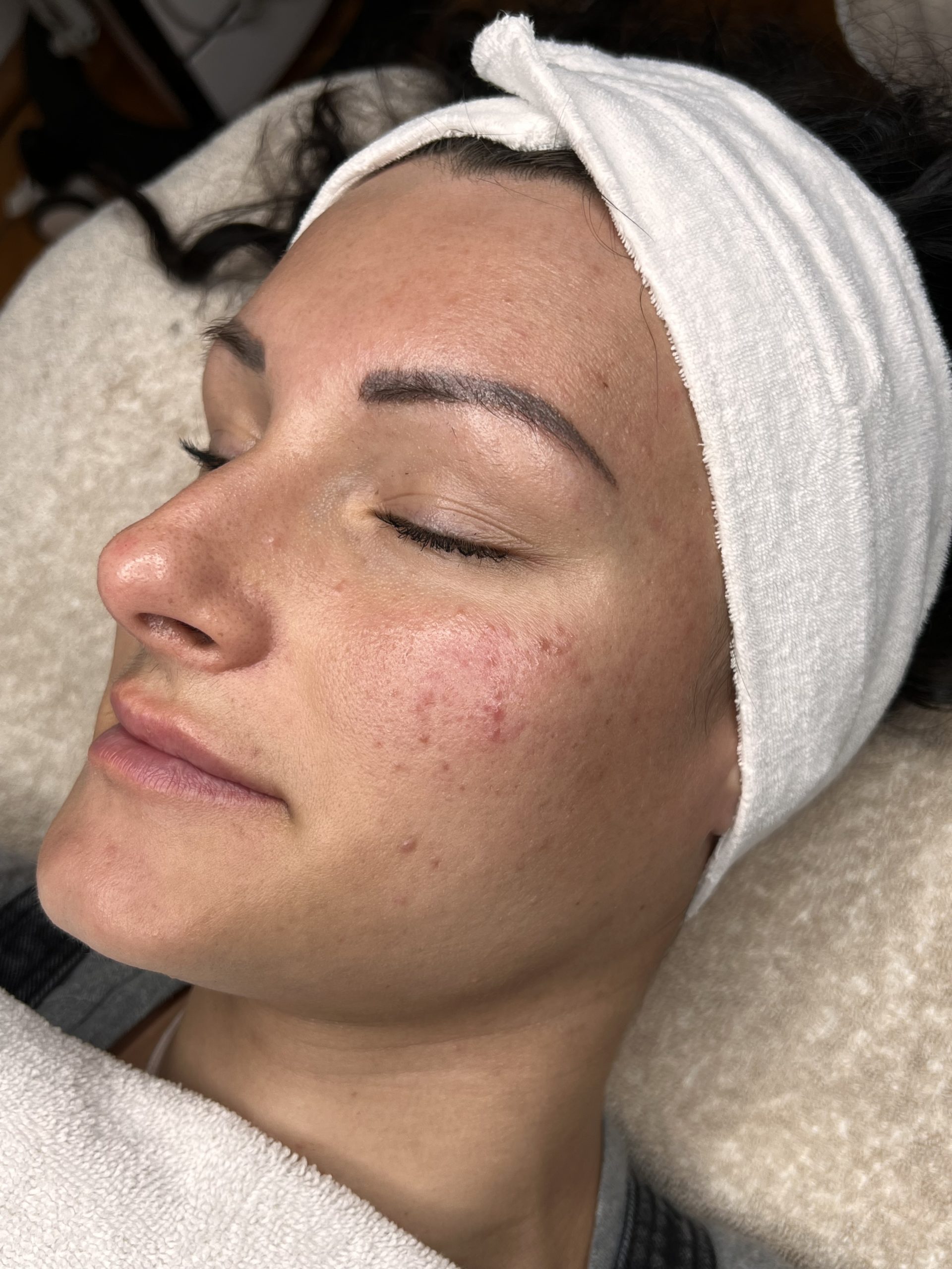 Microneedling Radiofrequenz Wien