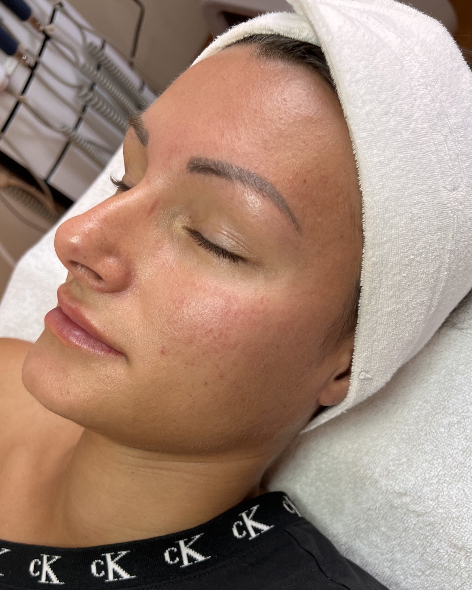 Microneedling Radiofrequenz Wien