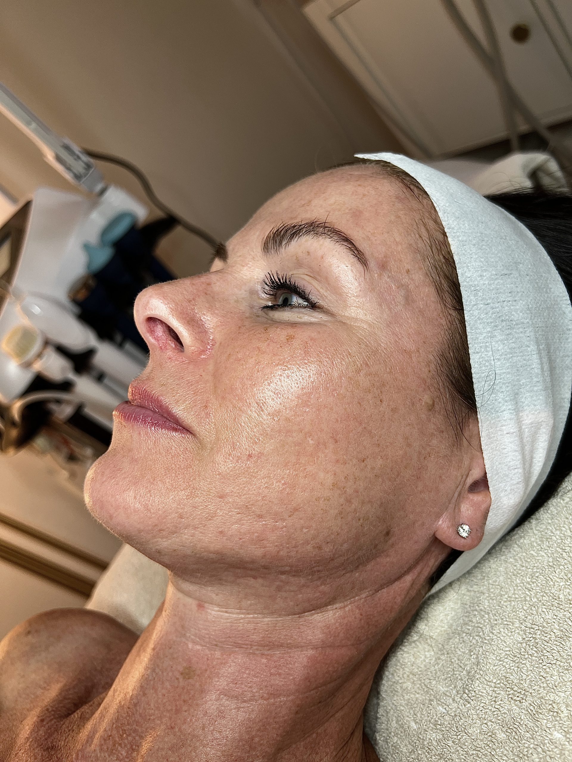 Microneedling Aknenarben Pigmentflecken