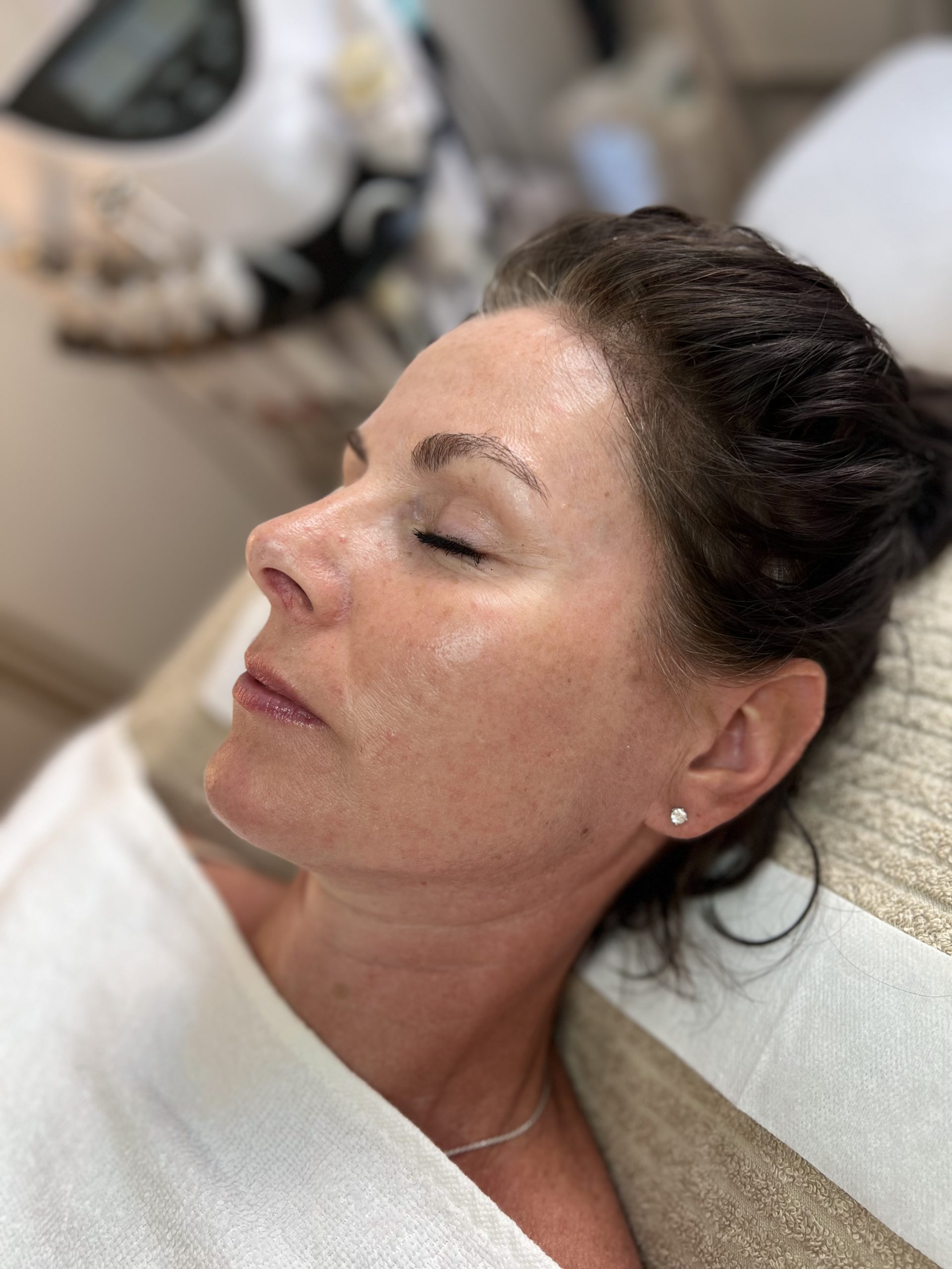 Radiofrequenz Microneedling Aknenarben